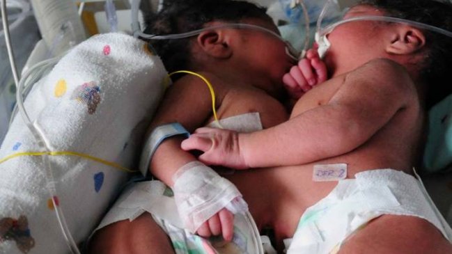  Siamesas nacen unidas por corazón e hígado  
