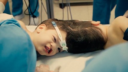   Milagro médico: Siameses unidos por el cráneo son separados con éxito 