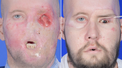   Hito médico: Paciente recibe exitoso primer trasplante de ojo completo 