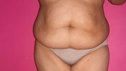   Cómo acceder al Bono PAD para abdominoplastía y reconstrucción mamaria 