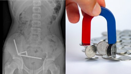   Niño sufrió grave lesión intestinal tras ingerir 100 imanes en Nueva Zelanda 