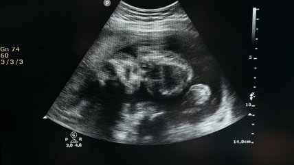   Consumir alimentos ultraprocesados afecta la fertilidad humana y el desarrollo del feto 